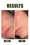 Anti - Acne Kit - Ophelia