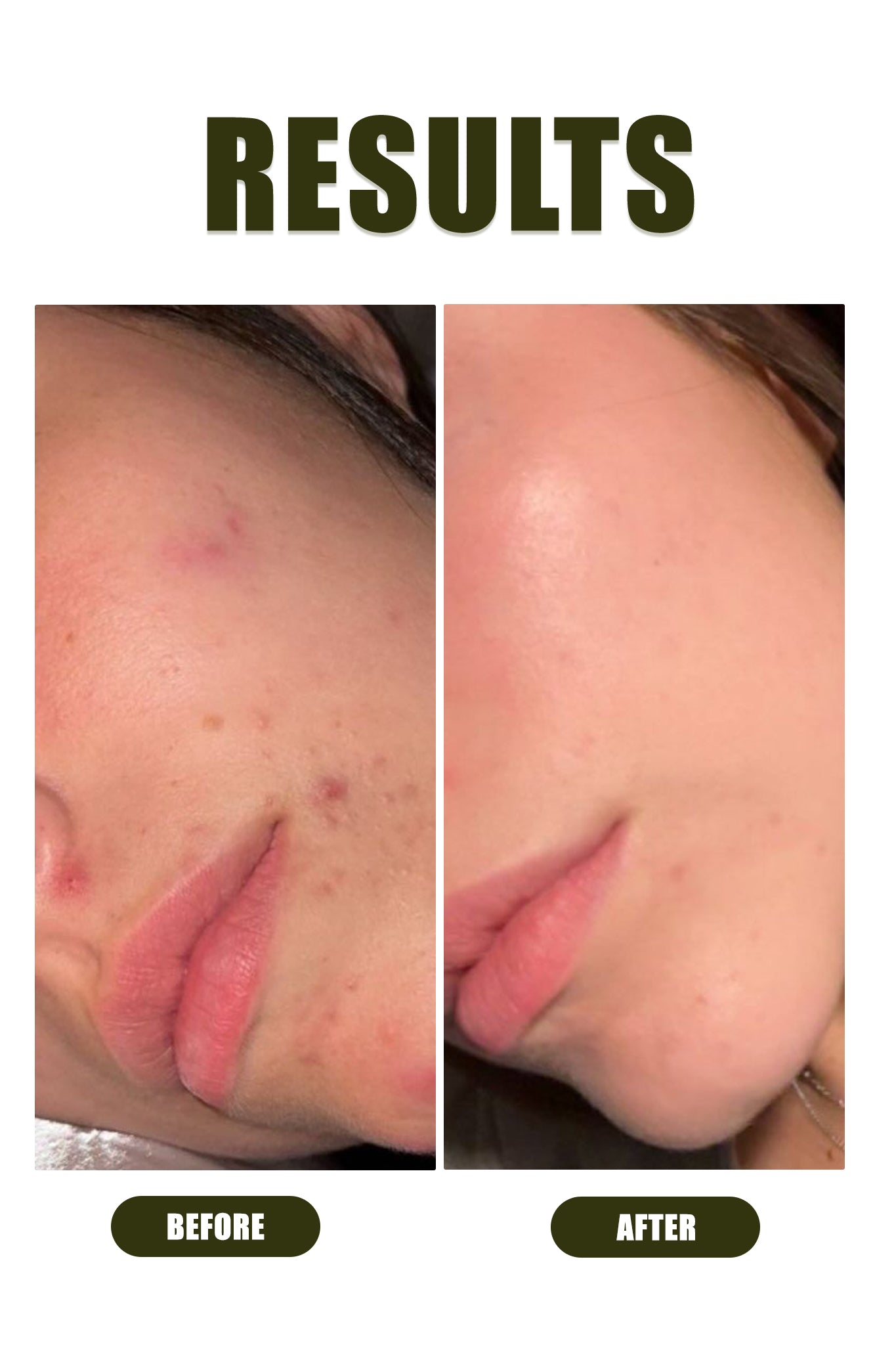 Anti - Acne Kit - Ophelia