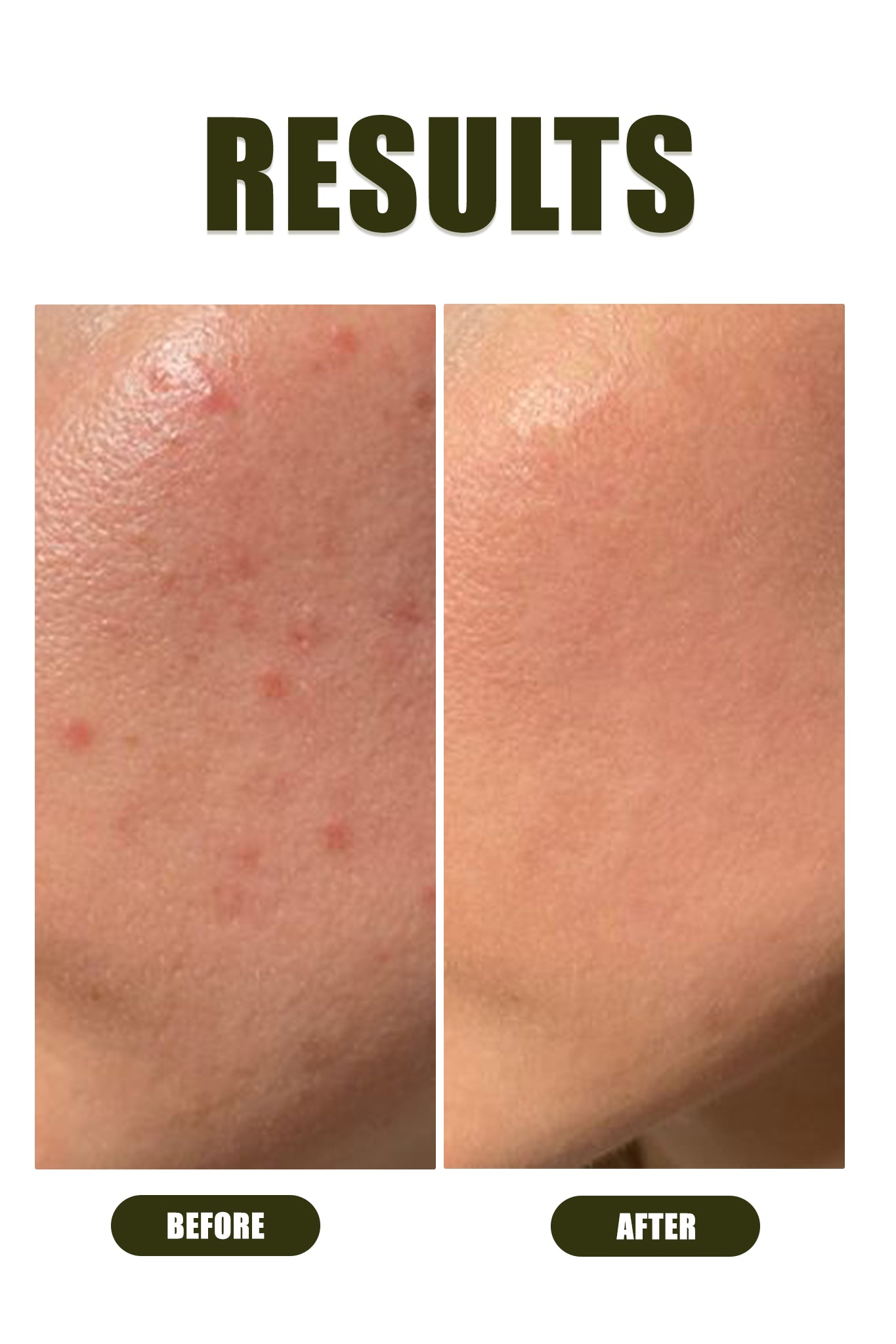 Clear Vibes Anti - Acne Serum - Ophelia