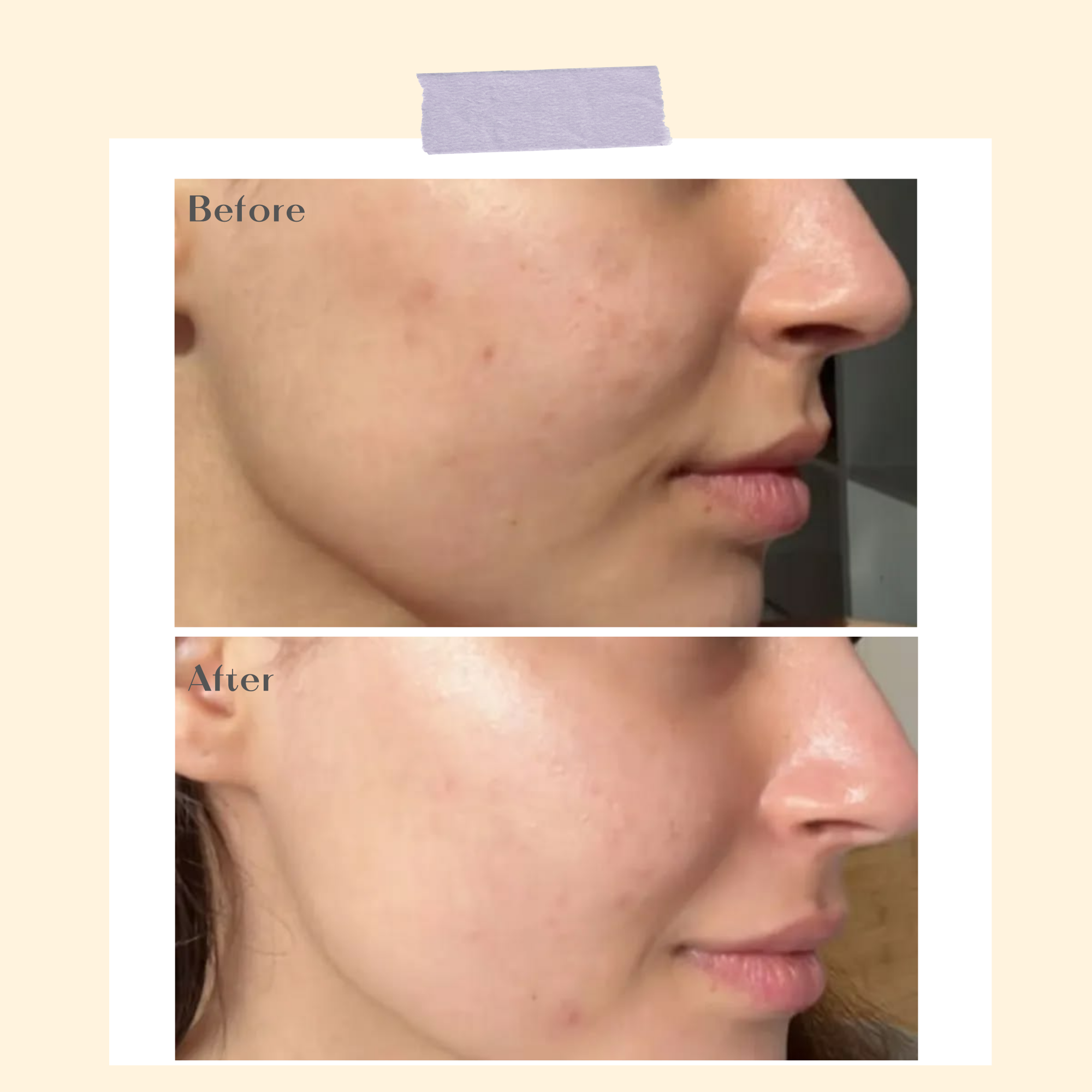 Clear Vibes Anti-Acne Serum - Ophelia