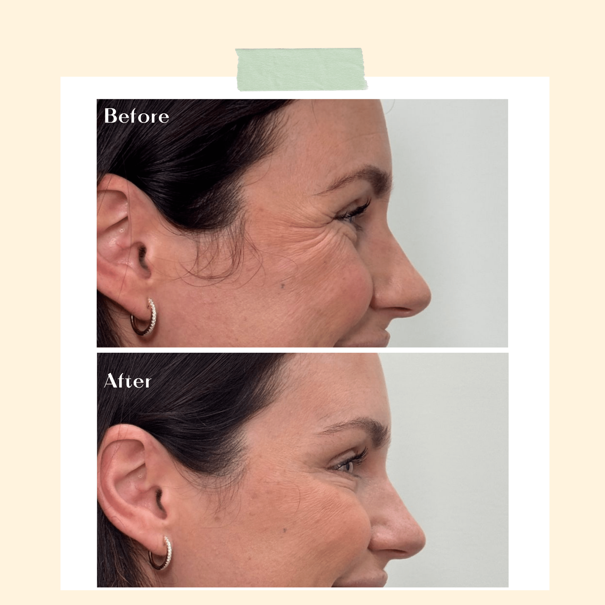 Advanced Botox Alternative Serum - Ophelia